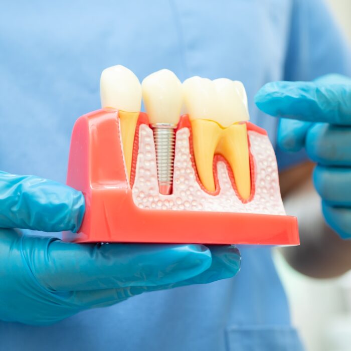 Dental implant, artificial tooth roots into jaw, root canal of dental treatment,