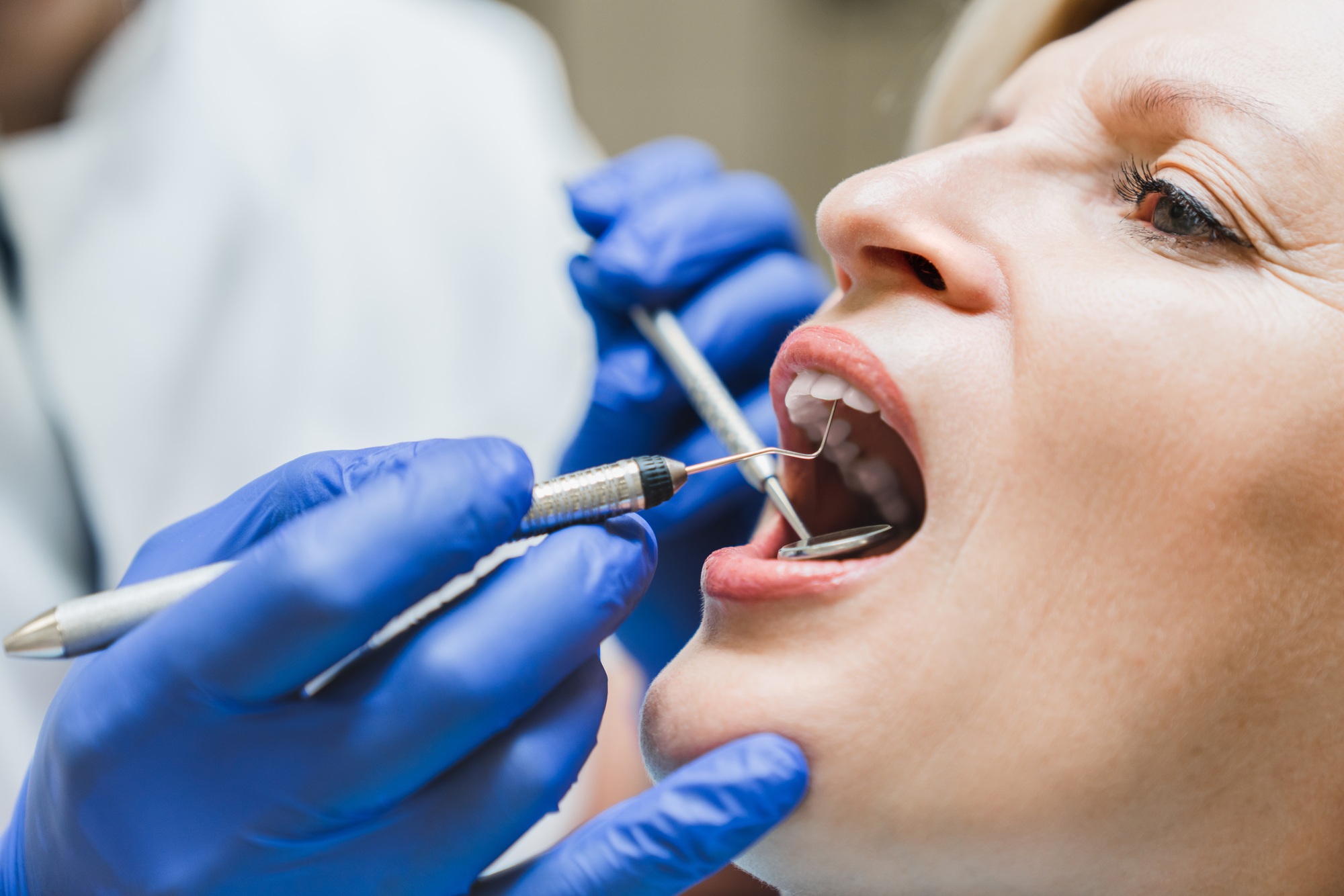 Female opened mouth with dental equipment mirror. Decay caries healing